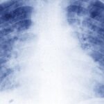 France : «une situation de tuberculose» déclarée en région parisienne, des dépistages organisés pour les cas contacts